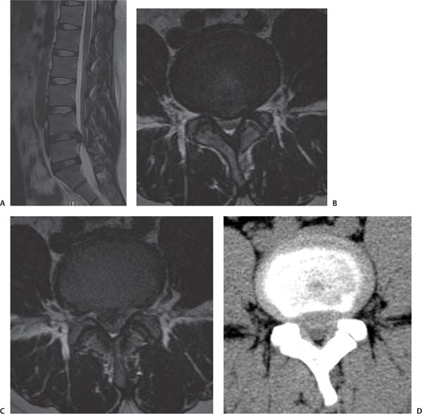 18 Case Presentations And Surgical Technique: Percutaneous Endoscopic ...