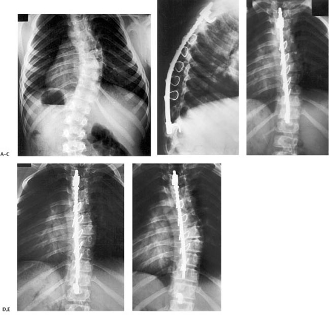 1 History Of The Treatment Of Scoliosis | Neupsy Key