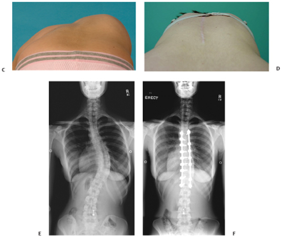 14 Posterior Correction Techniques In Late-onset Scoliosis | Neupsy Key