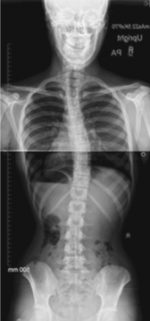 9 Classification Of Adolescent Idiopathic Scoliosis For Surgical ...