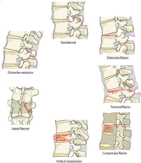 6.5 Thoracolumbar Spine Trauma Classification Systems | Neupsy Key