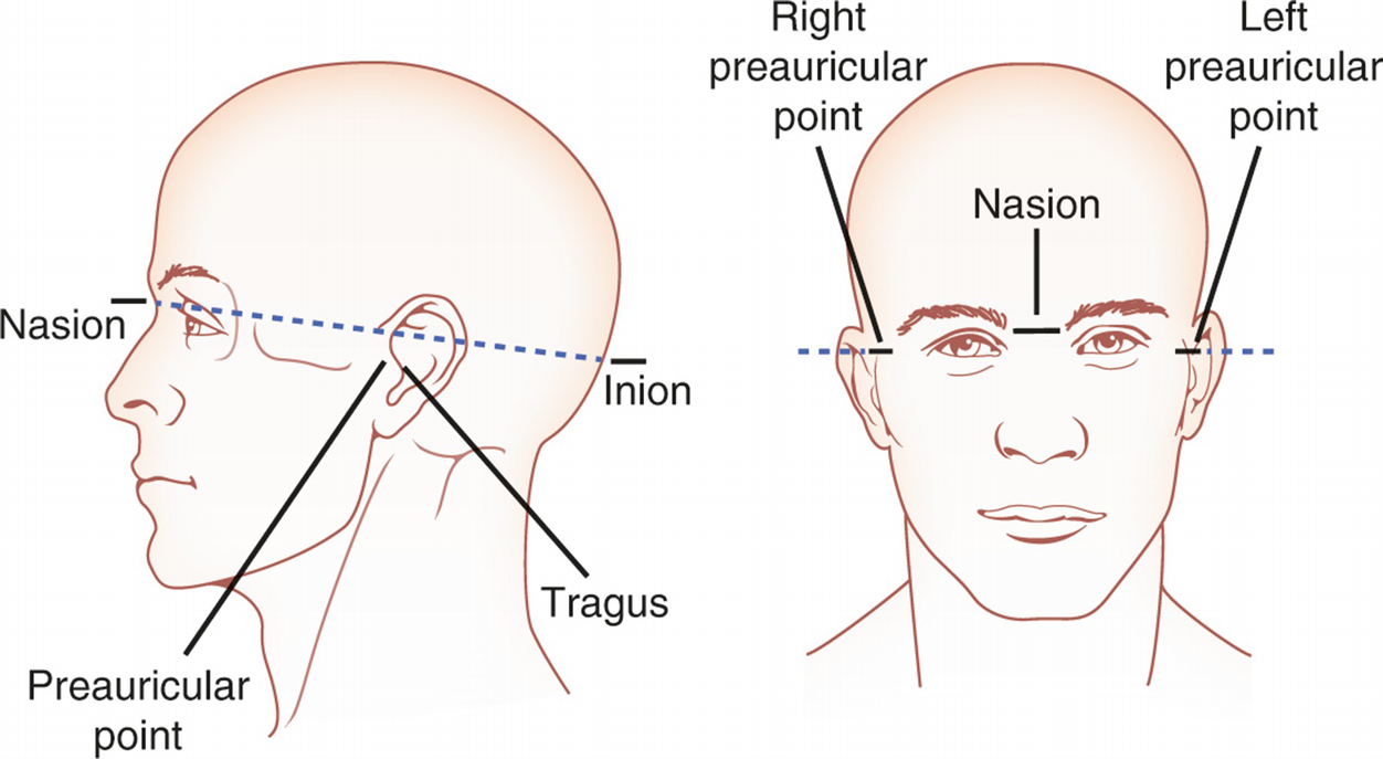 Profile points. Глабелла назион. Назион носа. Точка nasion. Назион на черепе.