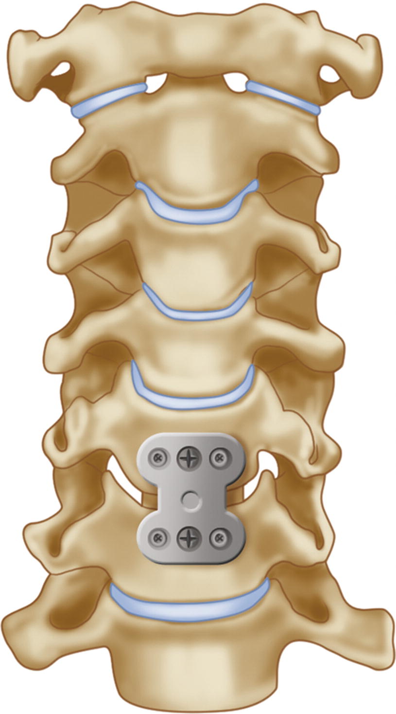 Procedures of the Spine | Neupsy Key