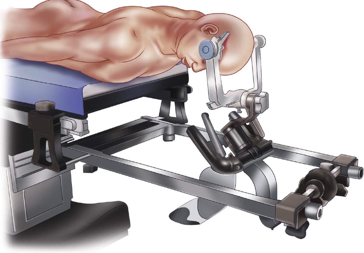 Procedures Of The Spine Neupsy Key