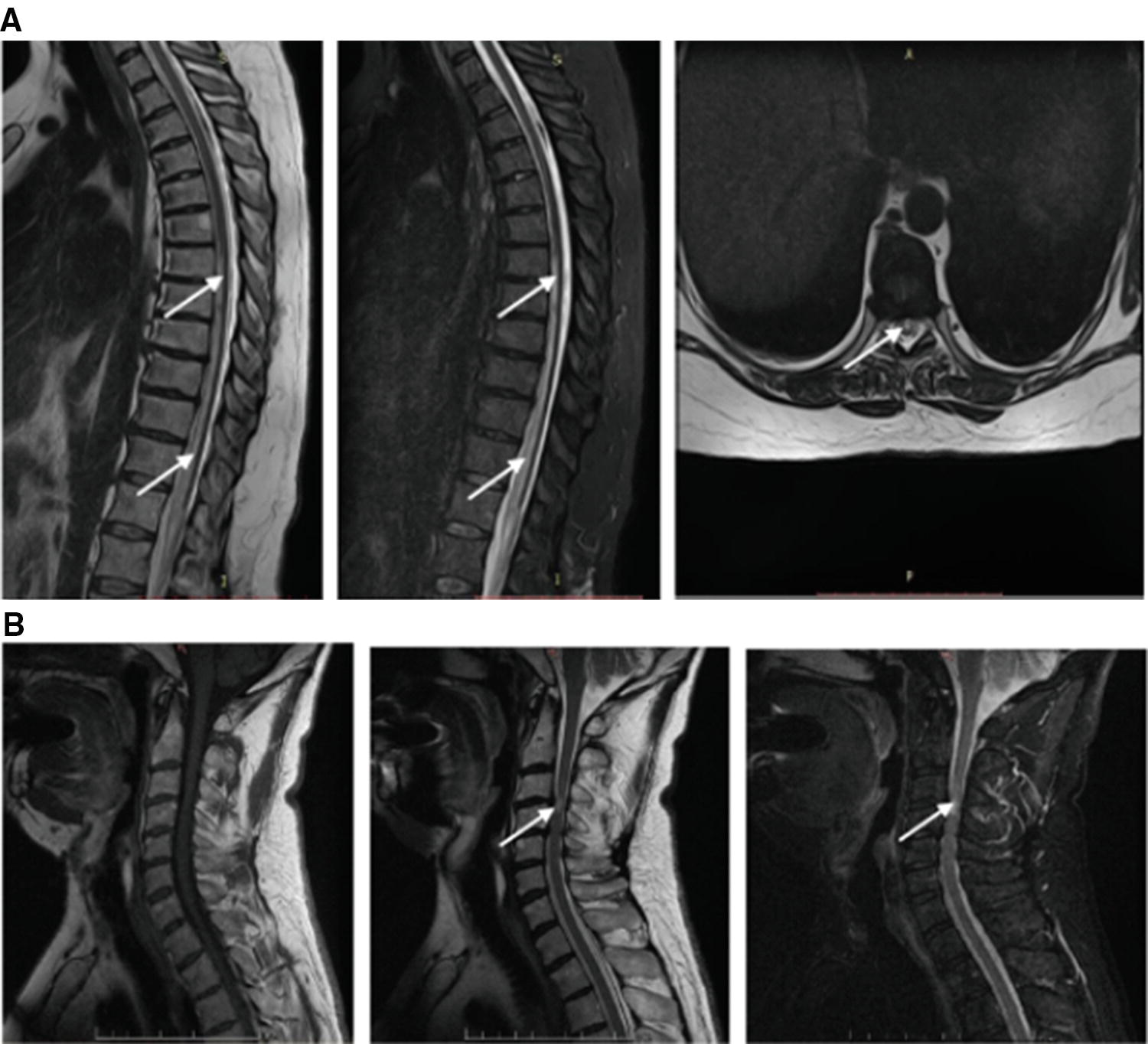 to NMDA Receptors in Cerebral and Spinal Cord Infarctions | Neupsy Key