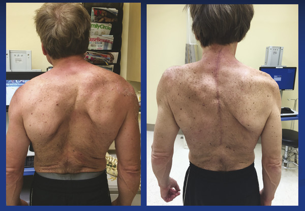 Example of a patient with cervicothoracic deformity before and after surgical correction. This patient presented with severe neck pain and was unhappy with his appearance.