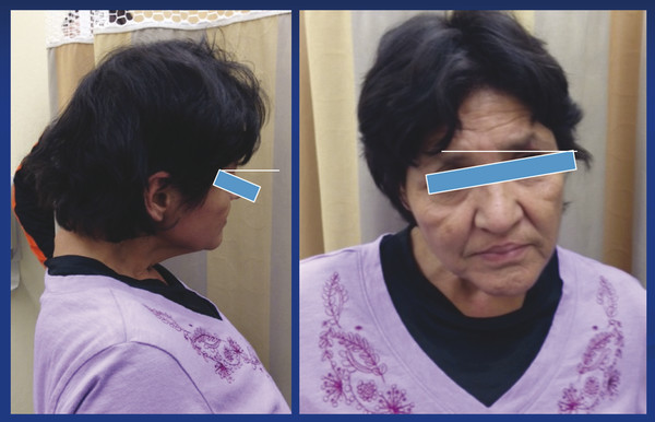 Abnormal static posture in a patient with cervical spinal deformity. She experiences neck pain and head position fatigue that is worse at the end of the day.