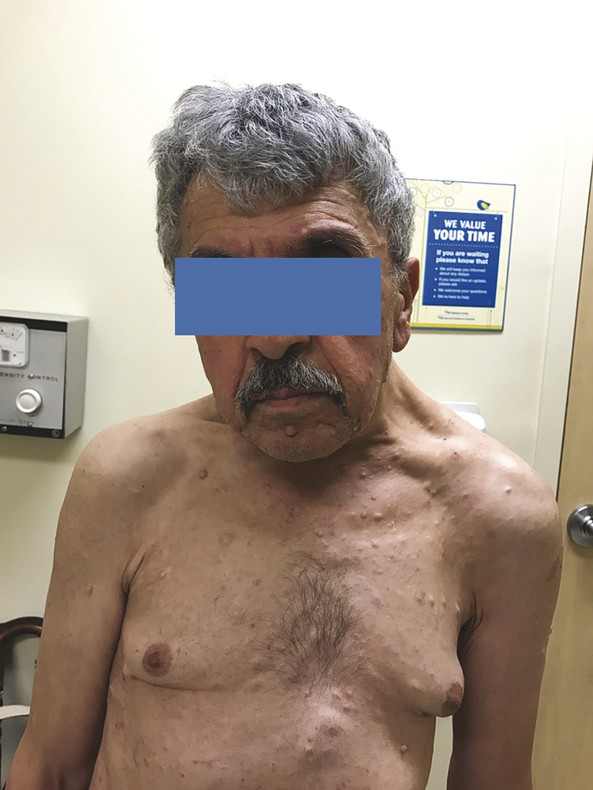 Patient with asymmetric left trapezius activation and hypertrophy due to cervical spine deformity.