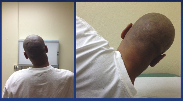 Patient with rigid neck deformity, 2 years after motorcycle accident resulting in amputations of right arm and left leg.