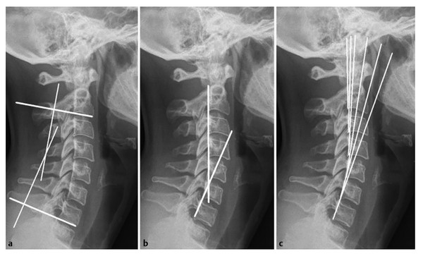 Sagittal radiographs showing the modified Cobb method (a), Jackson physiological stress line (b), and Harrison posterior tangent (c) for determining cervical lordosis. (Reproduced with permission from