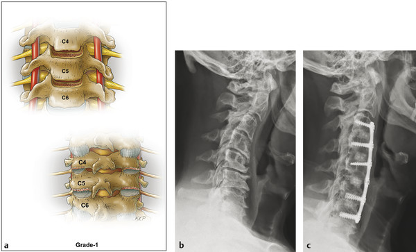 (a) Grade 1 osteotomy, anterior cervical discectomy, partial uncovertebral joint resection, or partial facet joint resection. Pre- (b) and postoperative radiographs (c) depicting anterior cervical dis
