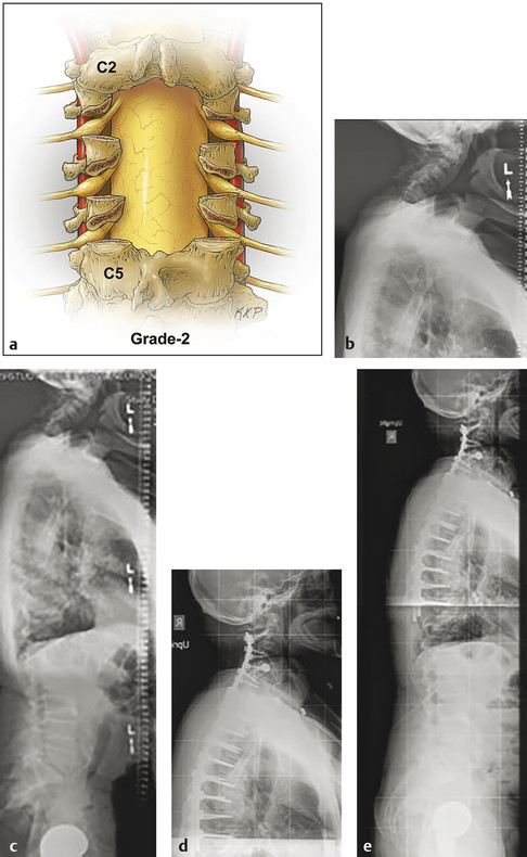 (a) Grade 2 osteotomy, complete facet joint resection. Pre- (b,c) and postoperative radiographs (d,e) depicting osteotomies with complete facet joint resections at C3–C4, C4–C5, C5–C6, C6–C7, and C7–T