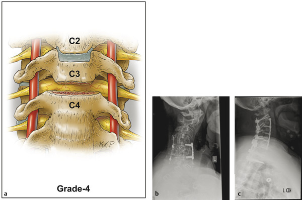 (a) Grade 3 osteotomy, partial or complete corpectomy. Pre- (b) and postoperative radiographs (c) depicting complete anterior corpectomies at C4 and C5 (Grade 3, modifier A).