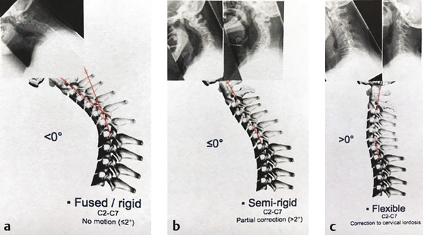 The “three types of cervical flexibility.”