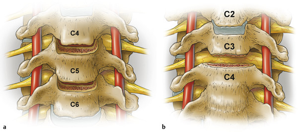 Anterior uncinate osteotomies. (Reproduced with permission from Ames et al.)