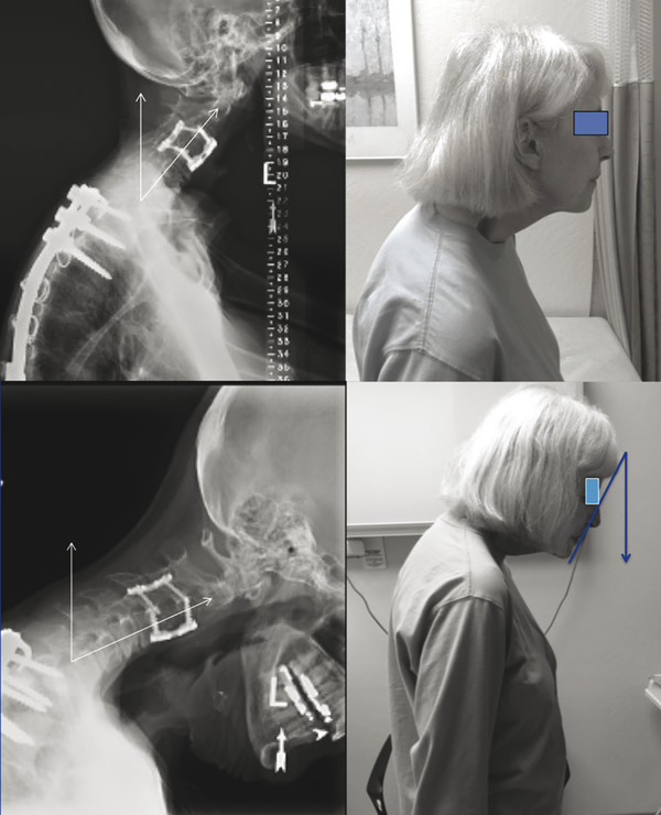 Examples of positioning for evaluation of radiographic parameters. In the top panel, the patient is instructed to look forward. In the bottom panel, the patient is instructed to take a position of com