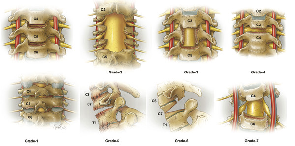 The seven grades of cervical osteotomies offering progressive degrees of destabilization and correction. Please refer to the text for detailed description by grade.