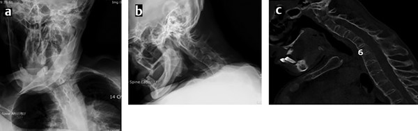 Preoperative AP (a) and lateral (b) X-rays, and sagittal CT (c) of a patient with severe cervical kyphosis with scoliosis, resulting in significant sagittal malalignment.