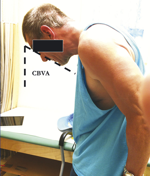 A clinical photograph demonstrating the CBVA measurement.