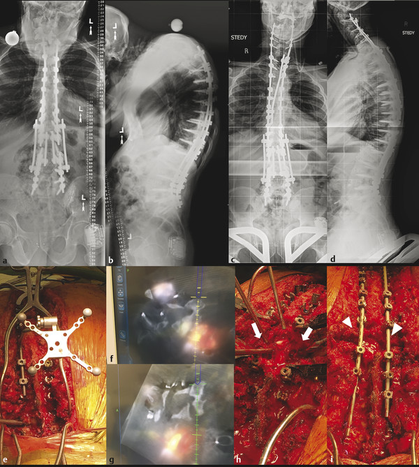 Preoperative (a,b) radiographs of a 61-year-old male patient with a history of multiple thoracolumbar deformity surgeries and proximal junctional kyphosis at T3. A posterior vertebral column resection