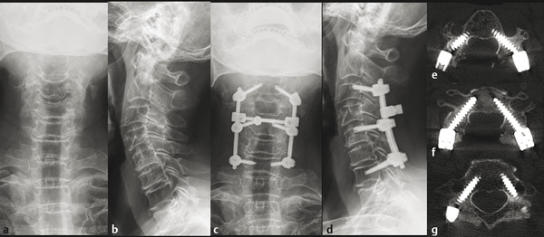 A 78-year-old female with multilevel cervical spondylotic myelopathy and history of severe osteoporosis (mean T-score at femur neck of -4.5) underwent posterior laminectomy and fusion from C3 to C7. P