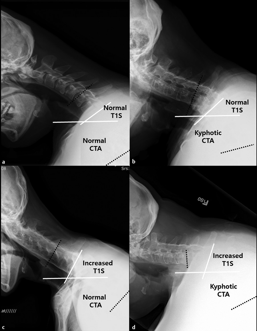 Radiographs showing four types of fixed cervical kyphosis with similar chin–brow vertical angle and C2–C7 sagittal vertical axis, with different T1 slope (T1S) and cervicothoracic angle (CTA). (a) Pat