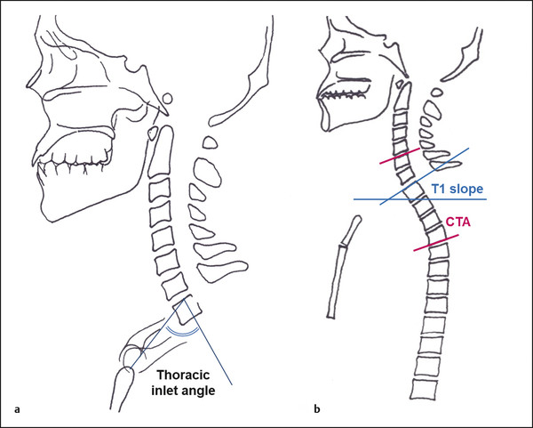 Schematic drawing of radiographic measurements of (a) thoracic inlet angle and (b) T1 slope and cervicothoracic angle (CTA).