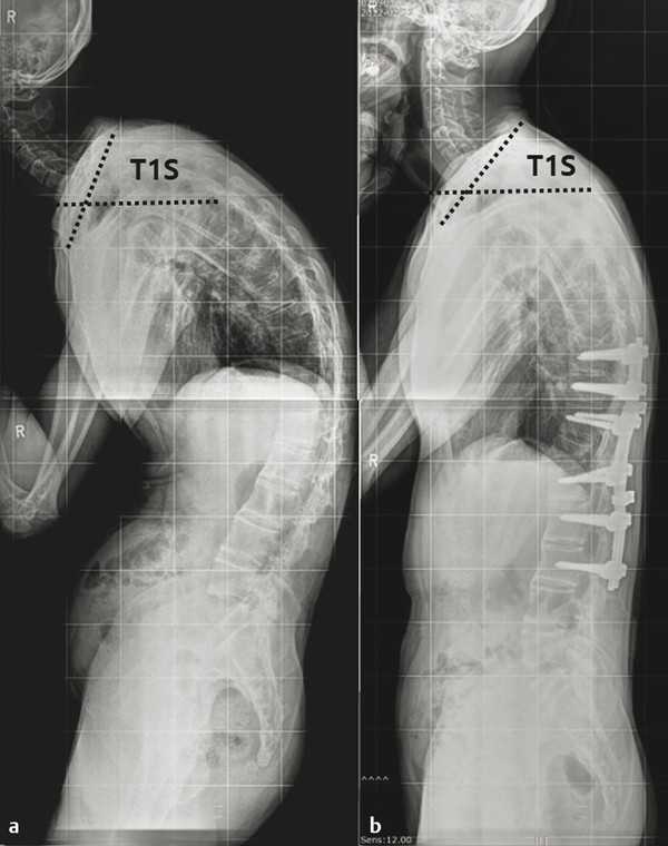 Preoperative (a) and postoperative (b) whole-spine standing radiographs of a 35-year-old man with ankylosing spondylitis. He had a fused thoracolumbar spine with kyphotic deformity but mobile cervical