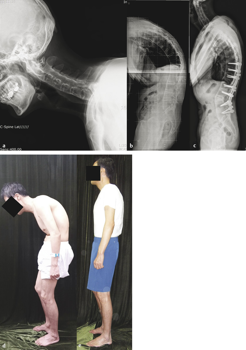 Preoperative cervical spine standing lateral (a) and whole-spine (b) radiographs of a 53-year-old man with ankylosing spondylitis. Preoperatively, the cervical to the thoracolumbar spine was autofused