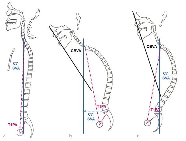Schematic drawings of (a) normal sagittal spinopelvic balance showing normal C7 sagittal vertical axis (SVA; blue line) (within 5 cm of the posterosuperior corner of the sacrum) and normal T1 pelvic a