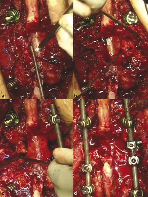 Intraoperative photographs of lumbar pedicle subtraction osteotomy. Sequential steps include (a) laminectomy and facet resection, (b) transverse process and pedicle removal, (c) decancellation of the 