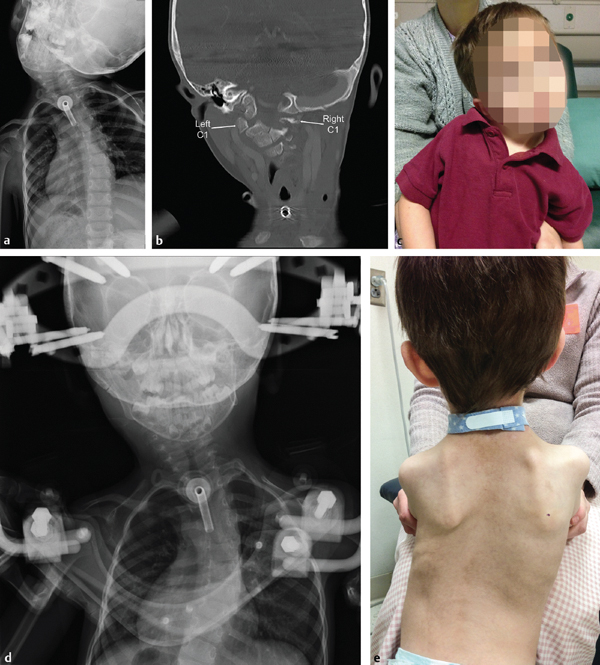 (a) Anteroposterior (AP) cervical radiograph of a 3-year-old male with Pierre–Robin syndrome and progressive torticollis secondary to right-side C1 hypoplasia. (b) Coronal CT scan demonstrating hypopl