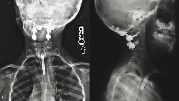 (f) Three year postoperative AP/lateral radiographs after occiput to C3 posterior spinal fusion. Compensatory right thoracic scoliosis has nearly completely resolved.