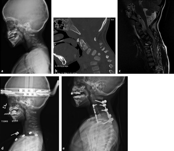 (a) Lateral radiograph of a 4-year-old male with Larsen syndrome and progressive myelopathy and ataxia secondary to progressive cervical kyphosis. (b) Sagittal CT scan demonstrates a wedge vertebra at
