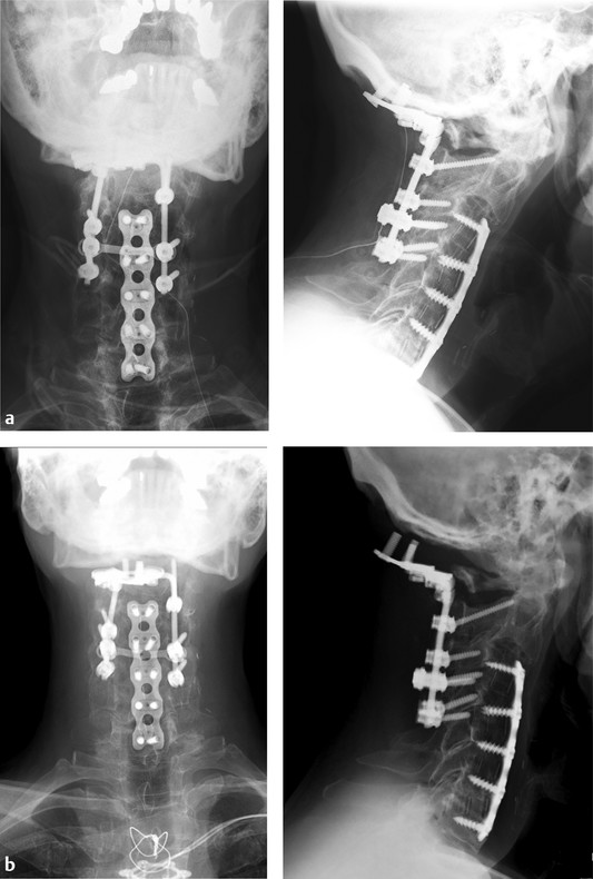 Case example: This 62-year old male had a previous C3–C7 anterior cervical discectomy performed several years prior. He had been recently treated by another surgeon and underwent a posterior procedure