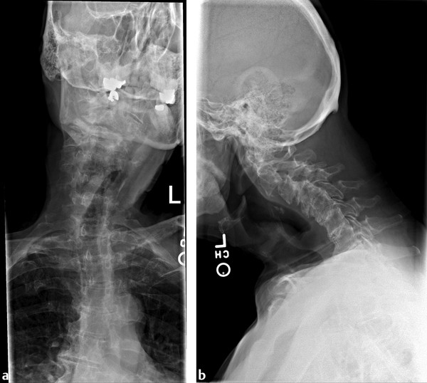 Preoperative radiographs. (a) A rigid coronal plane deformity that resulted in a “cock-robin” head position. (b) A neutral latera, demonstrating significant loss of normal lordosis.