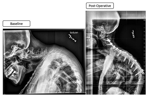 Cervical deformity patients with myelopathy who improved only in alignment. Pre- and postoperative radiographs of a cervical deformity patient with baseline myelopathy symptoms. This is a 73-year-old 