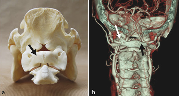 (a) Posterior view of dried quadruped's specimen shows the craniovertebral junction and broad C1 posterior arch (arrow). (b) 3D reconstruction CTA shows normal C1 arch (black arrow) on the right side 