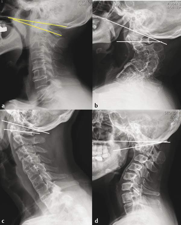 Lateral X-ray shows normal alignment of the cervical spine. In most occasions, cervical lordosis occurs at the C1–C2 segment. C0–C1 segment is kyphotic and C1 slope is posteriorly slanted (a). C1 slop