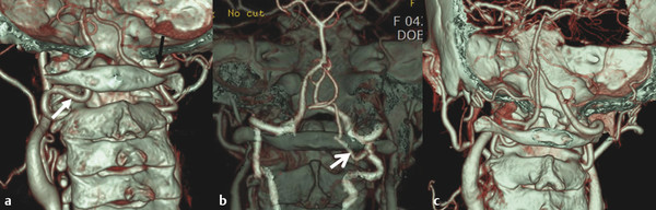 3D CTA images show three different types of V3 segment anomaly. (a) 3D CTA demonstrates the persistent intersegmental artery on the left side (white arrow), the VA course abnormally below the C1 arch 