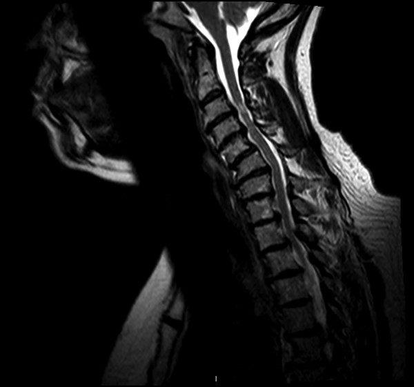 MRI demonstrating cervical deformity.