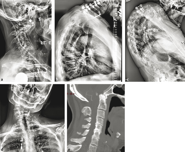 Example cases demonstrating the five deformity descriptor types of the Ames cervical deformity classification system. (a) Lateral radiograph demonstrating deformity apex in cervical spine; C classific