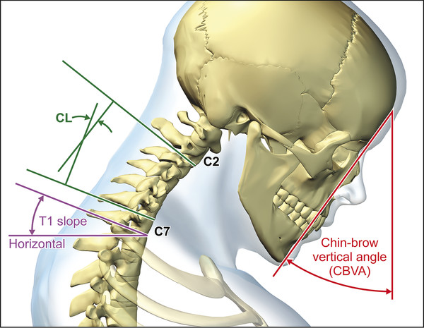 Chin–brow vertical angle is the angle between a line connecting a patient’s chin and brow and a vertical line (red lines). Cervical lordosis (CL) is obtained measuring angle between inferior endplate 