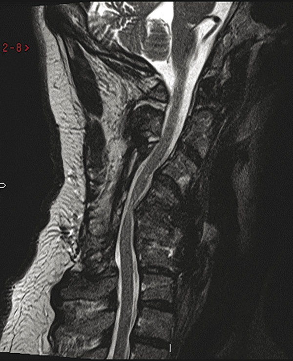 Sagittal MRI (T2) demonstrating neural compression of the spinal cord due to cervical kyphotic deformity, despite posterior decompression.