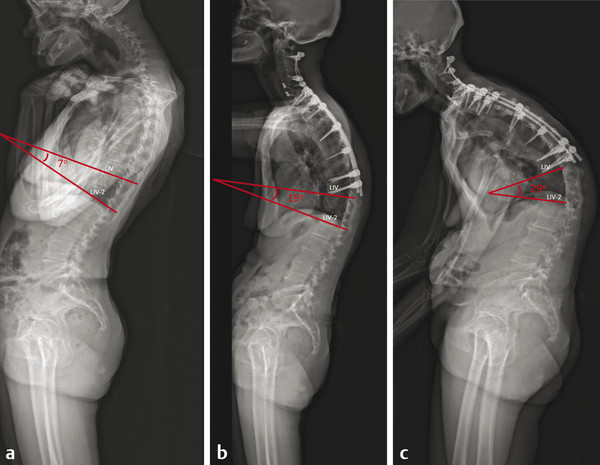 Preoperative (a) and postoperative (b,c) radiographs of a patient with severe cervical deformity. (b) Postoperative radiograph at 3 months following cervical deformity correction demonstrating early d