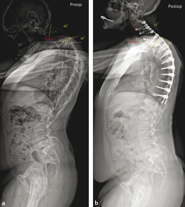 A 64-year-old male who presented with a chin-on-chest deformity. His cervical deformity started in 2 years earlier. He denies any trouble swallowing and has minimal neck pain. He struggles to ambulate