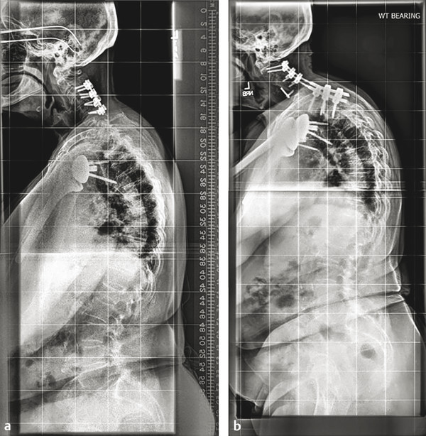 A 76-year-old female who underwent a C3 to C6 posterior cervical decompression and fusion for myelopathy had ongoing neck pain and adjacent breakdown below. She had significant baseline deformity with