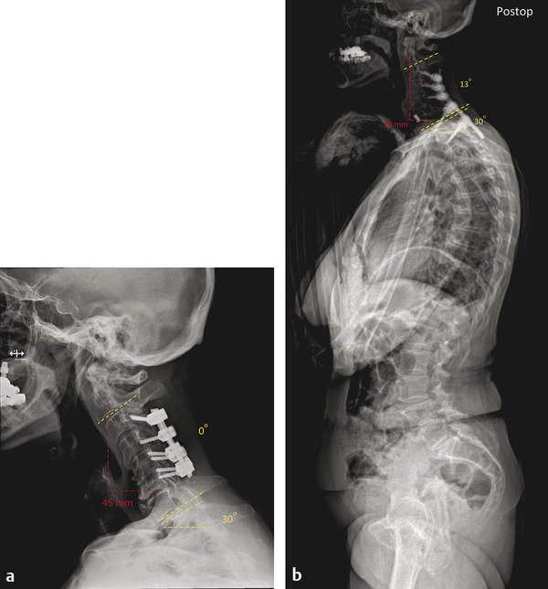 A 71-year-old female presented with axial neck pain post a C3–C6 posterior decompression and fusion with instrumentation for cervical myelopathy. She had been experiencing pain in her mid-neck region 