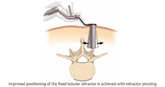 3 Posterior Retractor Systems | Neupsy Key