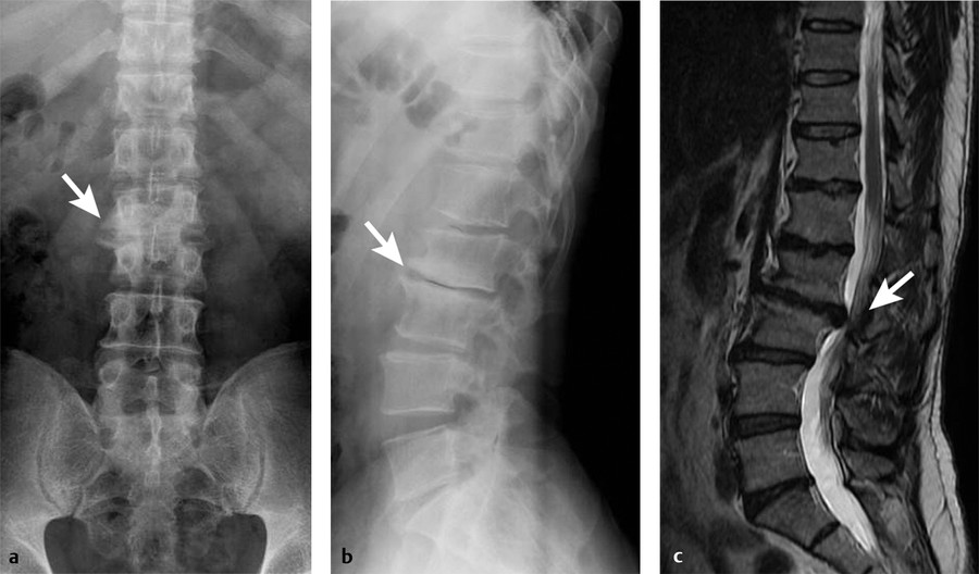 Minimally Invasive Lateral Transpsoas Interbody Lumbar Fusion | Neupsy Key